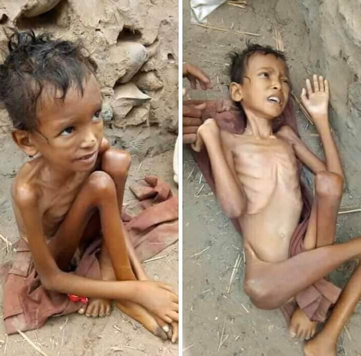 HiramSyeda's tweet photo. Yemen Hunger kills Yemen's children quietly, nobody hears #Yemen https://t.co/3H9c4OmJKB