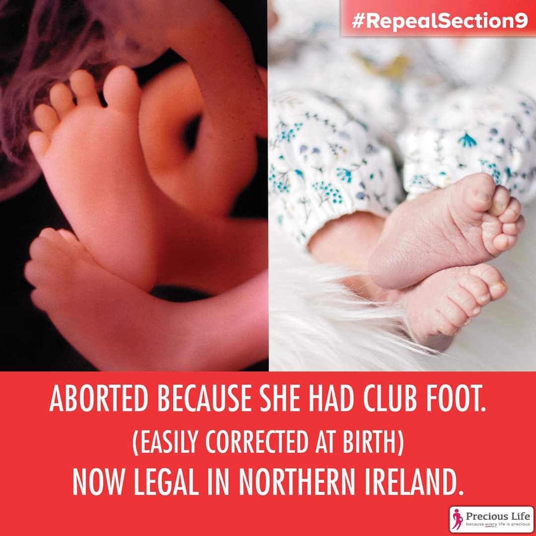 PreciousLifeCom's tweet photo. The UK Government have imposed abortion UP to Birth for babies diagnosed with disability including babies diagnosed with club foot,a condition easily corrected after birth
SIGN our urgent petition https://t.co/b6yUiWG7as
#WeAreThe79Percent #RepealSection9 https://t.co/vwWZAkzOwC