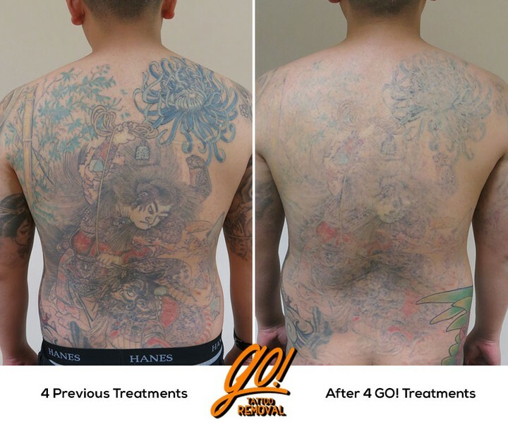 Full and Half Sleeve Tattoo Removal  Removery