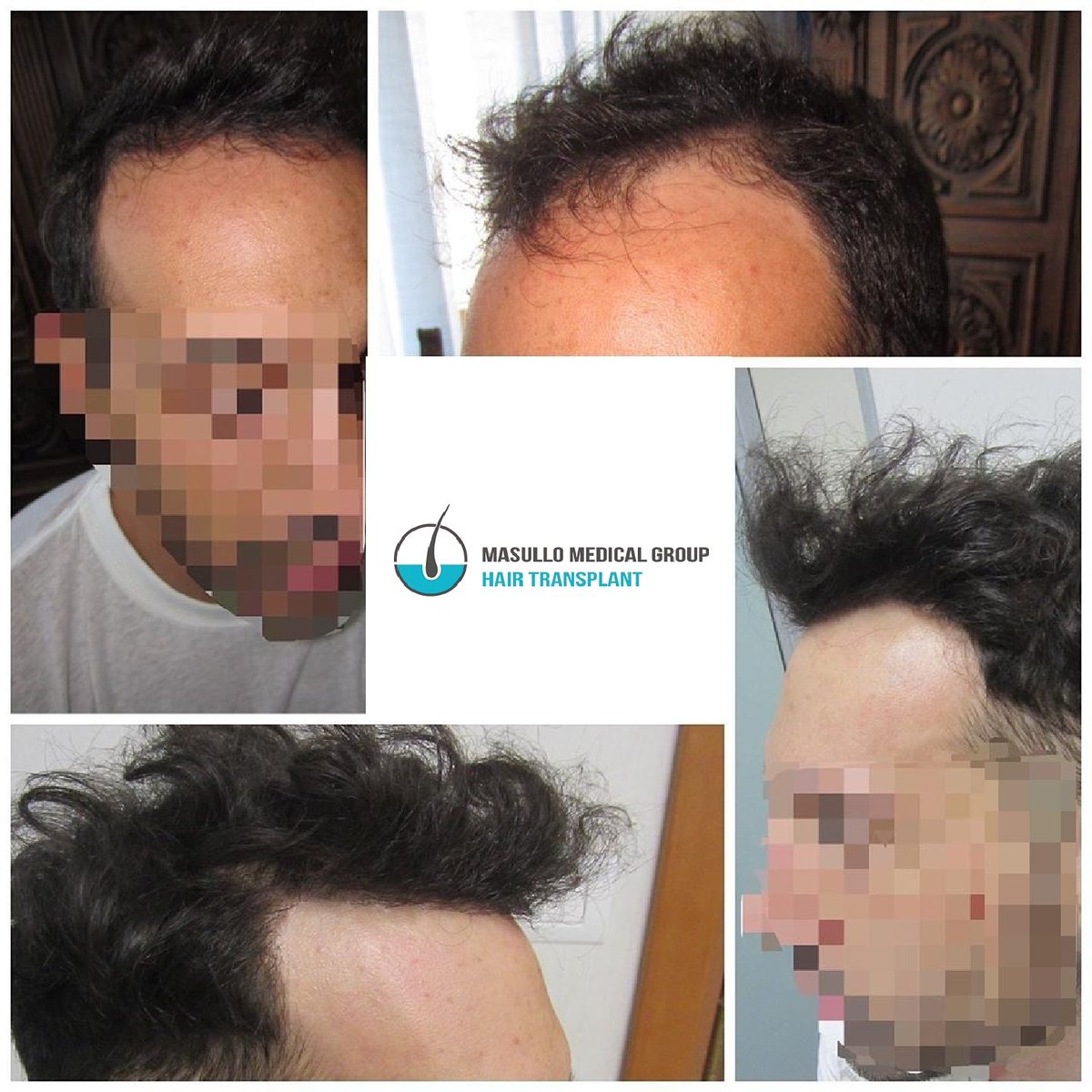 hairtra_masullo's tweet photo. #fue #hairtransplant 11 months later.
#hairtransplantation is the only #hairrestoration solution offering permanent results. The #fuemethod (with no visible scars and no stitches) surpassed what medications and #hairlosstreatments alone can do to treat #hairlossproblems➡️🌐📧📲 https://t.co/J3ICPRqV9P