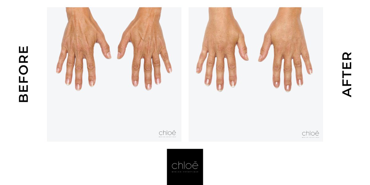 cliniquechloe's tweet photo. Treat Hands Wrinkles using Radiesse
​
​#handrejuvenation #aginghands #skincare #instabeauty #perfectskin #naturalskincare #health #radiesse #hands #hand #skin #botox #nosurgery #naturalresults #bestdoctor #montreal #mtl #ccmtl #cliniquechloe https://t.co/dU4VgEBOnq https://t.co/aYZpZXMsDK