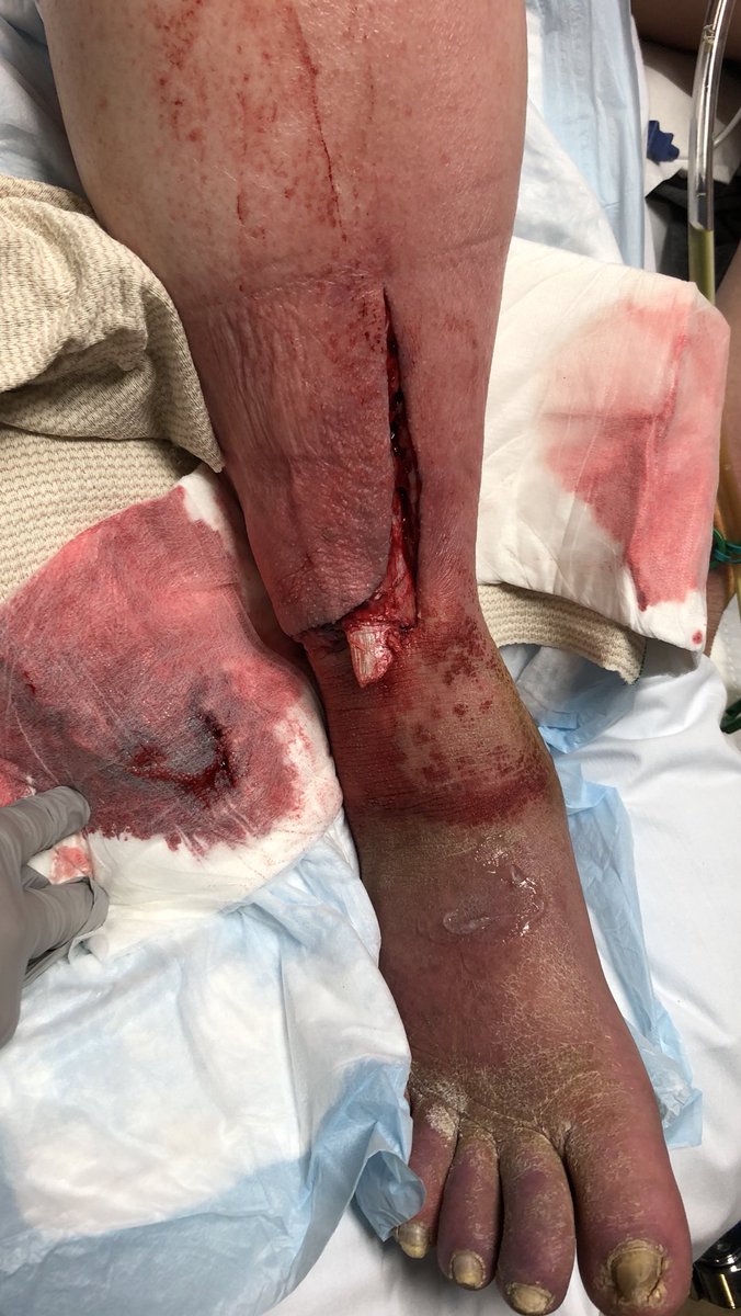 #orthotwitter How would you treat this?!?  CT does not show intra-articular extension.