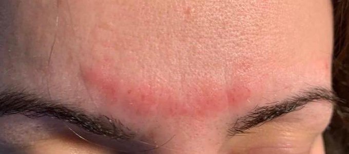 Estamos recibiendo consultas por problemas de #dermatología inducidos por el equipo necesario de protección (EPI + mascarillas + gafas/pantalla) para el #coronavirus.
La mayoría de los casos son decúbitos por presión continuada de distintas partes del equipo de protecc.
Abro hilo