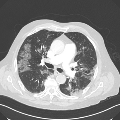 Patient admitted with dyspnea and abnormal CT scan. SARS CoV2 PCR negative on day #1 and #2. Turned positive on day #3. #COVIDー19 #IDtwitter
