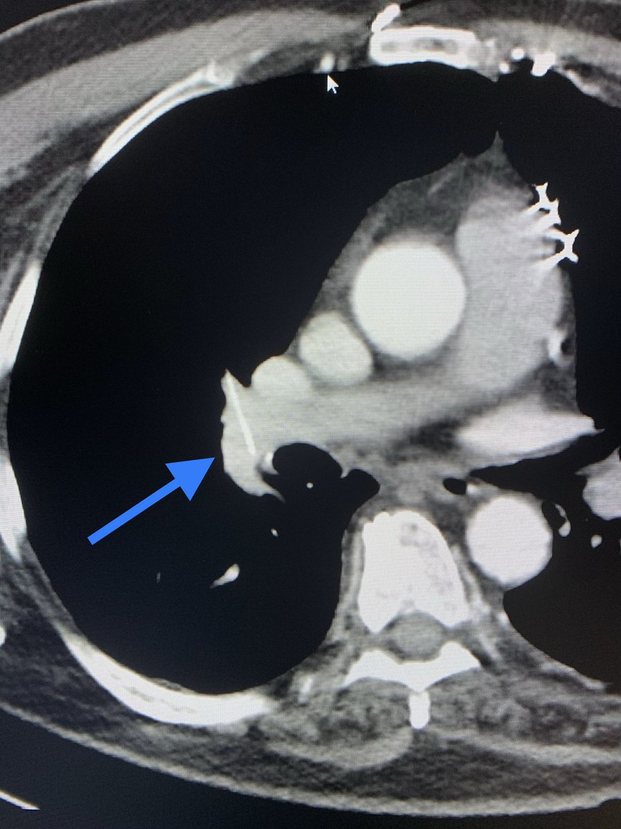 t_intheleadcoat's tweet photo. #wire #embolus in right #pulmonary #artery on CT. H/0 of #vascular #procedures and prior #CABG. unidentified source of #bacteremia needing admission. Leave it alone or retrieve ...patient wanted #retrieval. Pigtail #catheter to free one end and #snare. What would you do? #irad https://t.co/xGAxvEdwiK