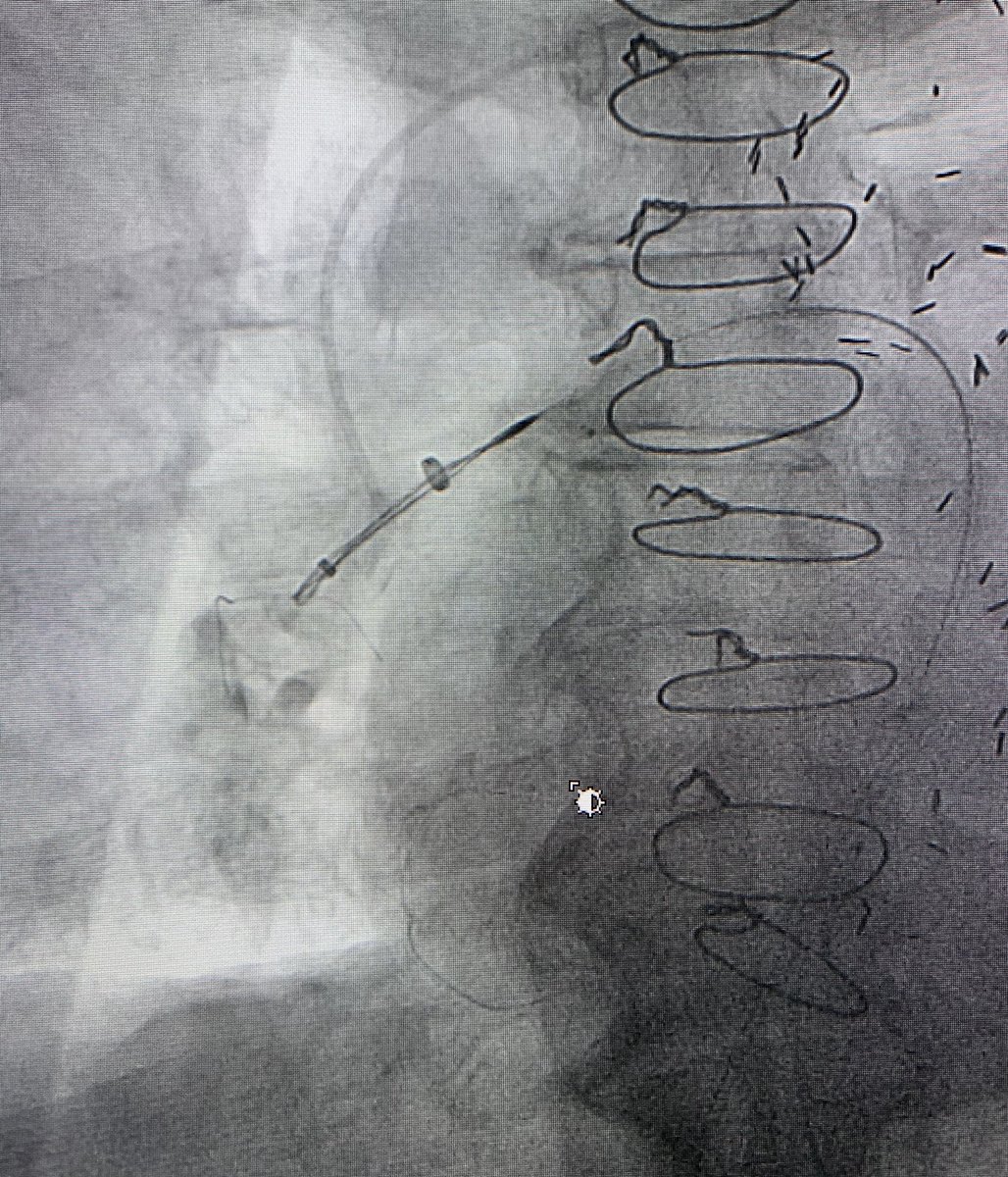 t_intheleadcoat's tweet photo. #wire #embolus in right #pulmonary #artery on CT. H/0 of #vascular #procedures and prior #CABG. unidentified source of #bacteremia needing admission. Leave it alone or retrieve ...patient wanted #retrieval. Pigtail #catheter to free one end and #snare. What would you do? #irad https://t.co/xGAxvEdwiK