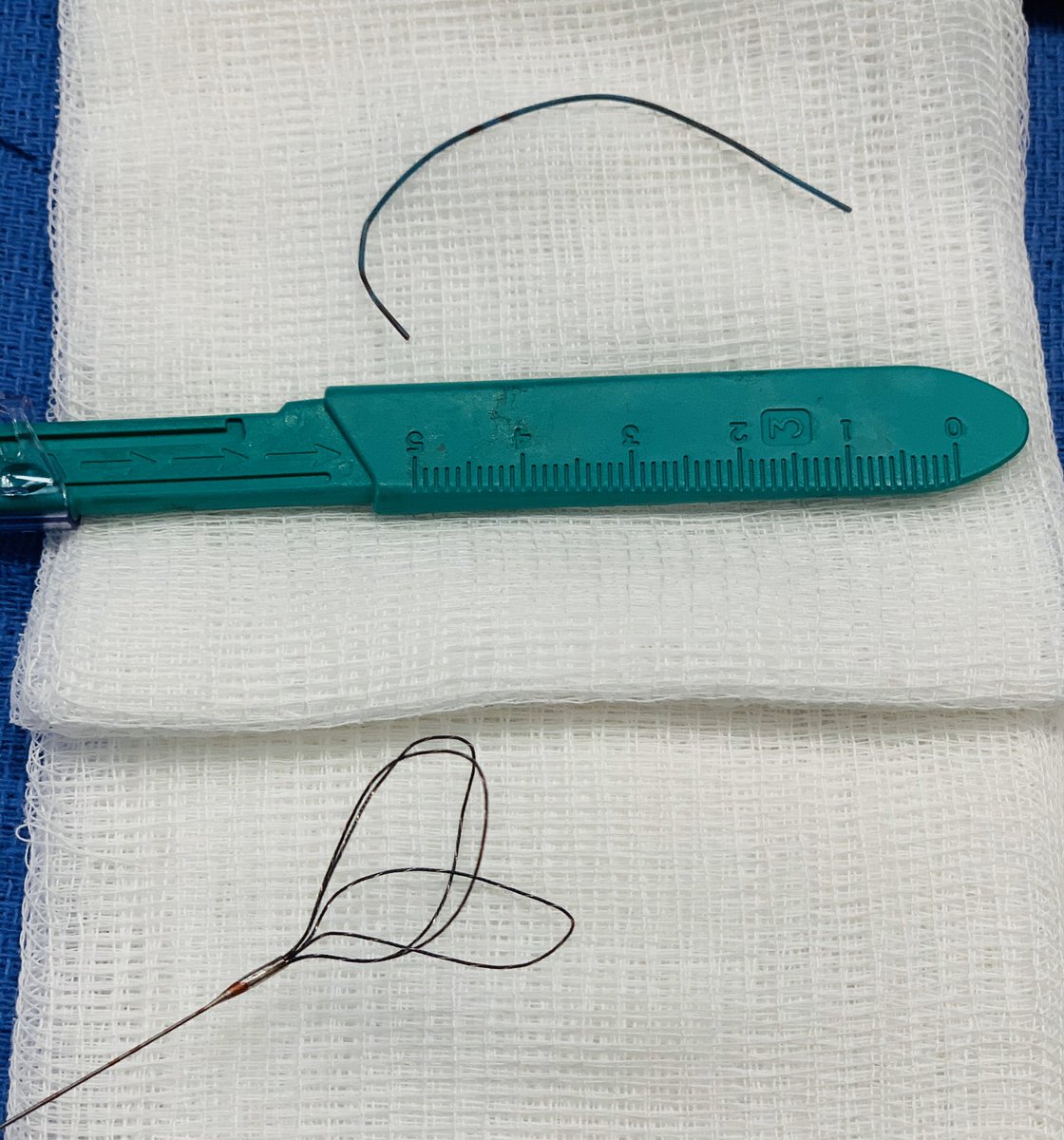 t_intheleadcoat's tweet photo. #wire #embolus in right #pulmonary #artery on CT. H/0 of #vascular #procedures and prior #CABG. unidentified source of #bacteremia needing admission. Leave it alone or retrieve ...patient wanted #retrieval. Pigtail #catheter to free one end and #snare. What would you do? #irad https://t.co/xGAxvEdwiK