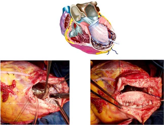 MorgannRollin's tweet photo. After MI, 20% of hearts undergo remodeling which can cause LV dilation. Surgical ventricular restoration is a new way to restore the LV to its proper shape and volume. A mannequin is used to guide suturing the ventricle into an elliptical shape. #biom4180 https://t.co/2w2Wpia4zG https://t.co/0jRH4u6Y63