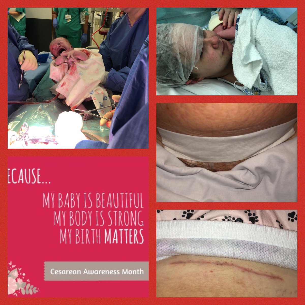 April is #CSection Awareness Month. Colby probably wouldn’t be here today if I didn’t have one. C-Sections aren’t the easy way out! We are still mums! #5monthsago #Awareness #Mummy #StillAMum #April