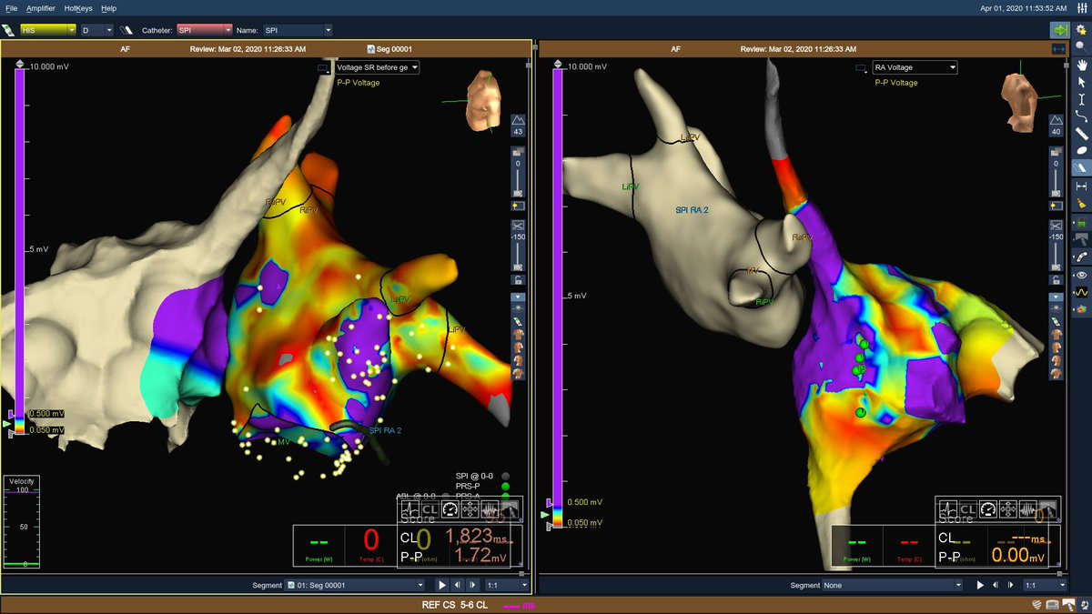MicheleB_MD's tweet photo. S/p PVAI, PW Isolation, CTI, intercaval line and isolation of the SCV for long standing #PersAF. Redo performed for PAF EHRA 3 to 4. Voltage maps display what it was found, all veins/lines still good. What would you #EPeeps have done? #ensite #flexability #kmd #af #ep https://t.co/inIUumKzKc