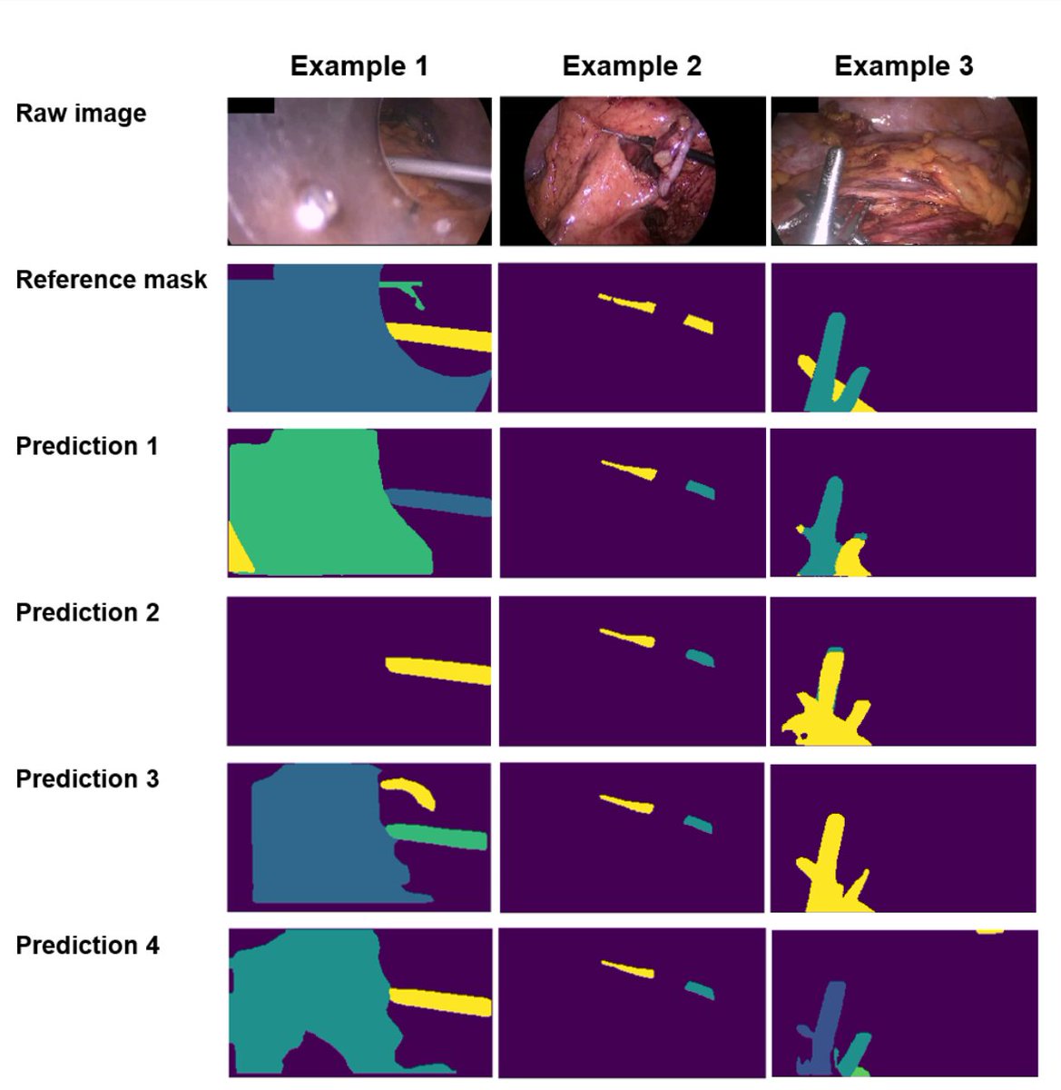 Results of the first multi-instance detection and segmentation challenge in laparoscopy are out. arxiv.org/abs/2003.10299. Detection works well. Segmentation challenges (see image) include: Endoscope lens in trocar,  instrument covered by tissue, crossing instruments. (1/2)