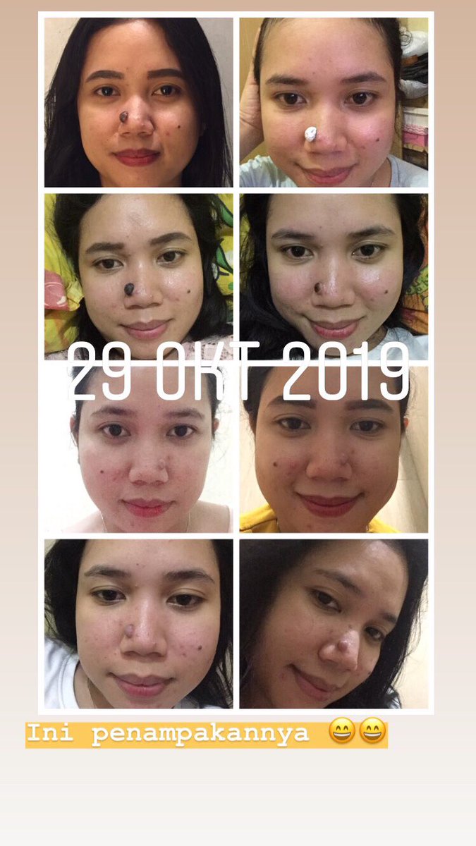 carolineolinw's tweet photo. Guys, ini pengalaman sy hilangkan tahi lalat hidup di hidung https://t.co/rgwXx5g990