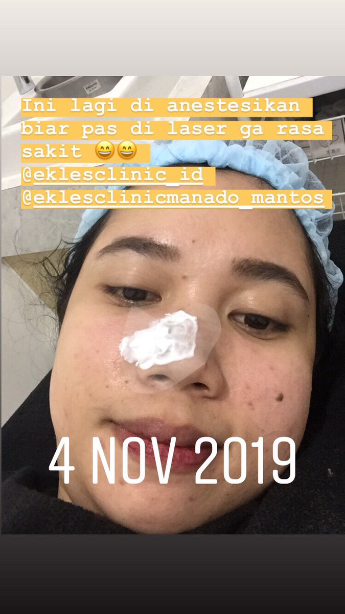 carolineolinw's tweet photo. Guys, ini pengalaman sy hilangkan tahi lalat hidup di hidung https://t.co/rgwXx5g990