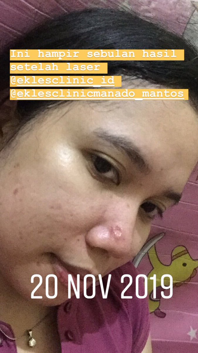 carolineolinw's tweet photo. Karna banyak bgt yang tanya cara ngilanginnya gmna https://t.co/ckAMsCDTxA