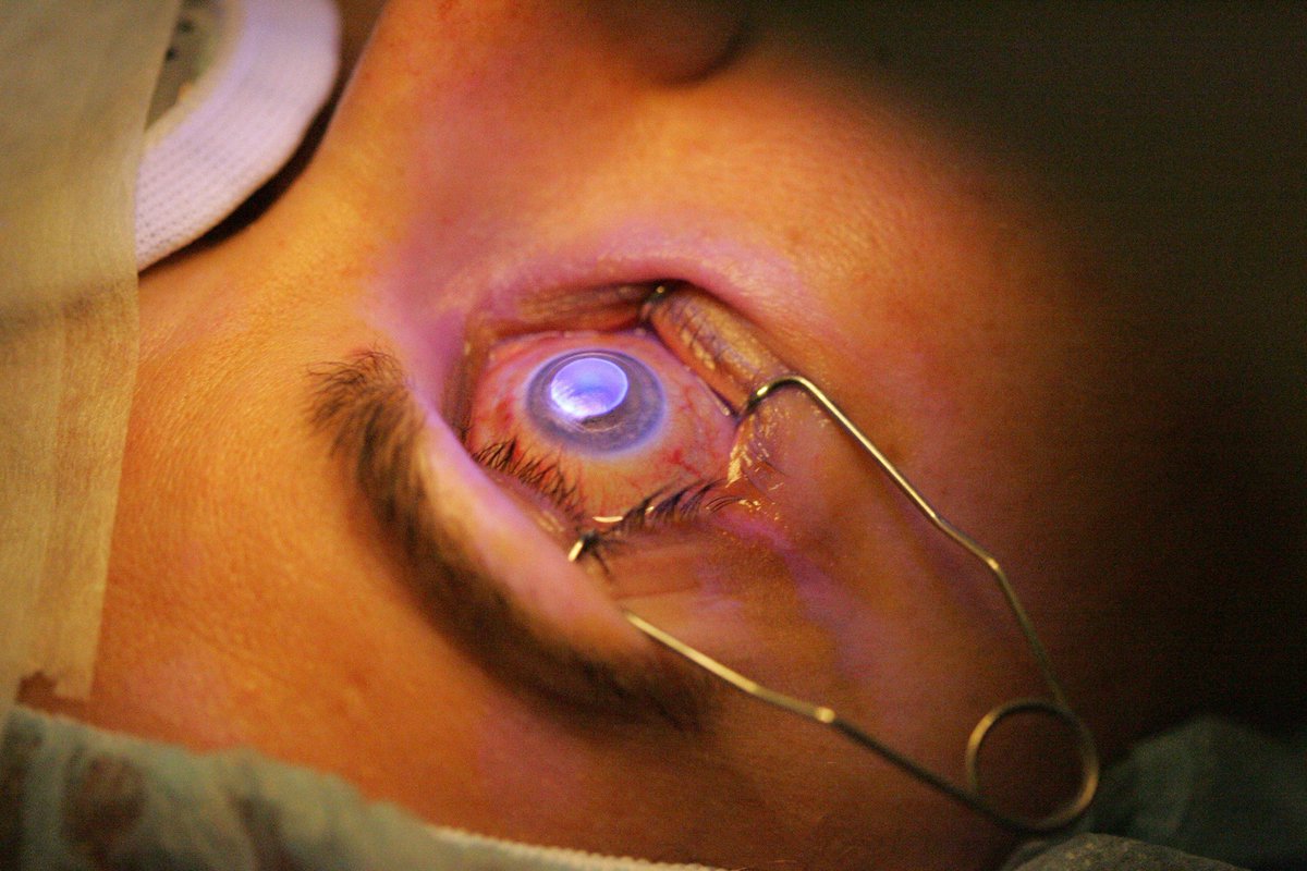 ¿Quién es un buen candidato para el LASIK? 

✅ Mayor a 18 años idealmente, más de 21 años, que es cuando es más probable que la visión haya dejado de cambiar.
✅ Sus córneas deben ser gruesas y saludables.

coi.org.mx #Oftalmologo #Monterrey #CuidaTusOjos