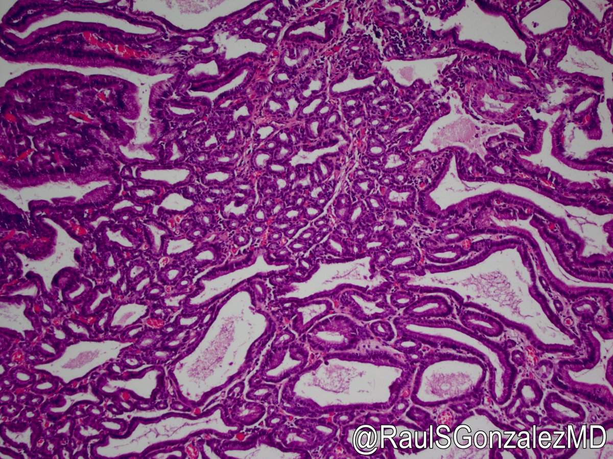RaulSGonzalezMD's tweet photo. I saw yesterday's GEJ case when I was in training. It was signed out as polypoid Barrett's with high-grade dysplasia. I got a teaching recut. A few years later, I came across it, took a look, and said wait a sec ... that's a pyloric gland adenoma! #pathology #gipath https://t.co/Y1PJL04kce