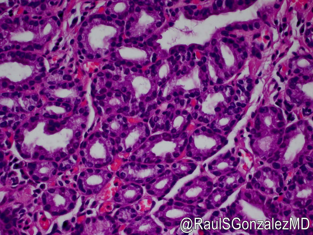 RaulSGonzalezMD's tweet photo. I saw yesterday's GEJ case when I was in training. It was signed out as polypoid Barrett's with high-grade dysplasia. I got a teaching recut. A few years later, I came across it, took a look, and said wait a sec ... that's a pyloric gland adenoma! #pathology #gipath https://t.co/Y1PJL04kce