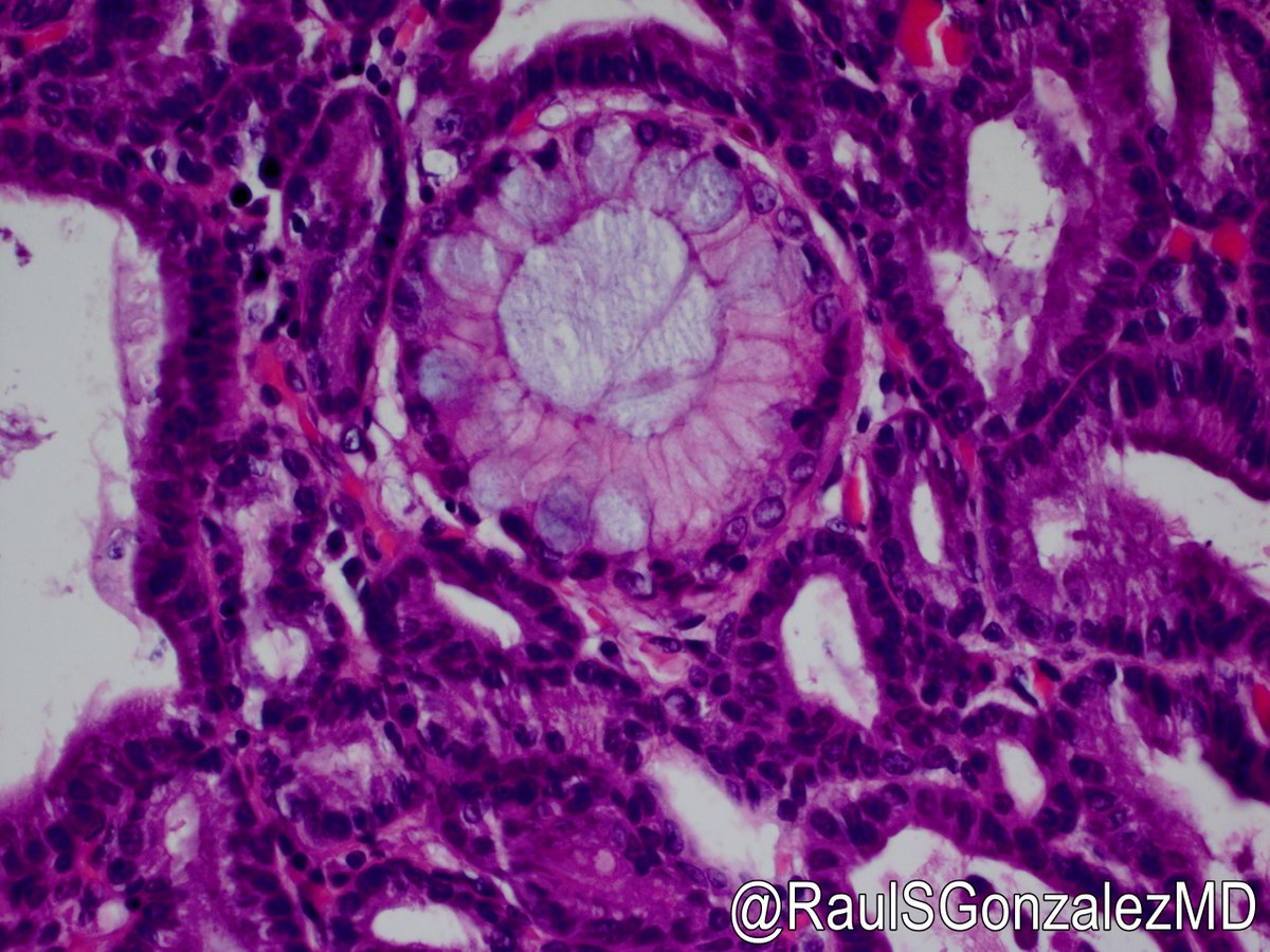 RaulSGonzalezMD's tweet photo. I saw yesterday's GEJ case when I was in training. It was signed out as polypoid Barrett's with high-grade dysplasia. I got a teaching recut. A few years later, I came across it, took a look, and said wait a sec ... that's a pyloric gland adenoma! #pathology #gipath https://t.co/Y1PJL04kce