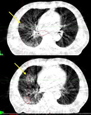 #COVID19 related pulmonary changes observed on #CBCT prior to onset of clinical symptoms (in #NSCLC patient treated with ChRT). Case preprint in process.
Watch your daily thoracic CBCTs!
with <a href="/MSuppli/">Morten Hiul Suppli</a> <a href="/mettepoehl/">Mette Poehl</a> <a href="/strimo/">Steen Riisgaard</a> <a href="/Rigshospitalet/">Rigshospitalet</a>
