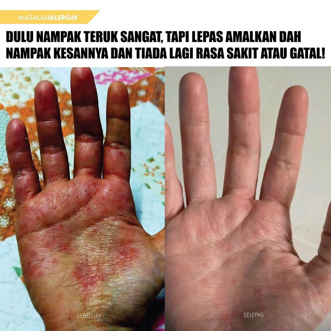 ØªÙÙØªØ± Cikya Ø¹ÙÙ ØªÙÙØªØ± Biasa Makan Ubat Dari Farmasi Kejap Je Elok Lepas Tu Teruk Balik Lepas Cuba Minum Calla Milk Suprisely Masalah Kulit Makin Elok Dan Kulit Cantik Balik