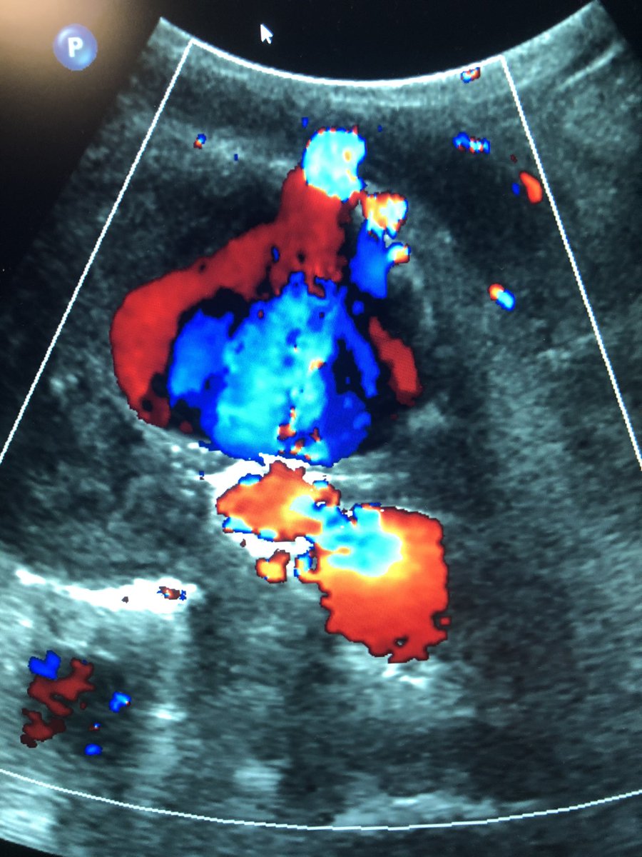 Type II endoleak, well visualized IMA feeding into the enlarging AAA lumen #endoleak #whoa #FOAMed #Withoutascalpel <a href="/Guthrie_Clinic/">Guthrie Clinic</a> <a href="/guthrie_ir/">GuthrieIR</a> <a href="/SIRspecialists/">Society of Interventional Radiology</a> <a href="/SIR_ECS/">SIR ECS</a>