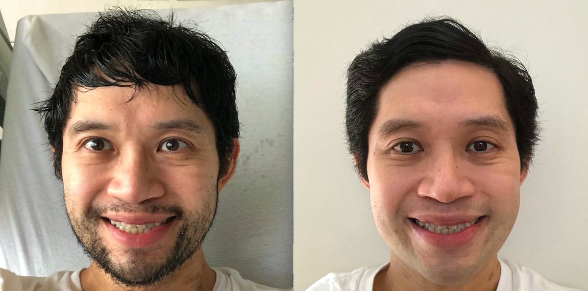 Before and after: my final hospital-bed selfie at  @nyulangone, before my discharge yesterday afternoon, and a photo taken after I got to shower, shave, floss, and moisturize, for the first time in weeks.  #coronavirus  #COVID19  #coronaboy  #latscovid19journal