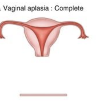 Trying to find a figure that explains what vaginal aplasia is to y'all and this is the closest I could find. Basically, since she didn't have a vagina, there was no way for sperm to reach her reproductive tract via the conventional route. This is usually a congenital defect.