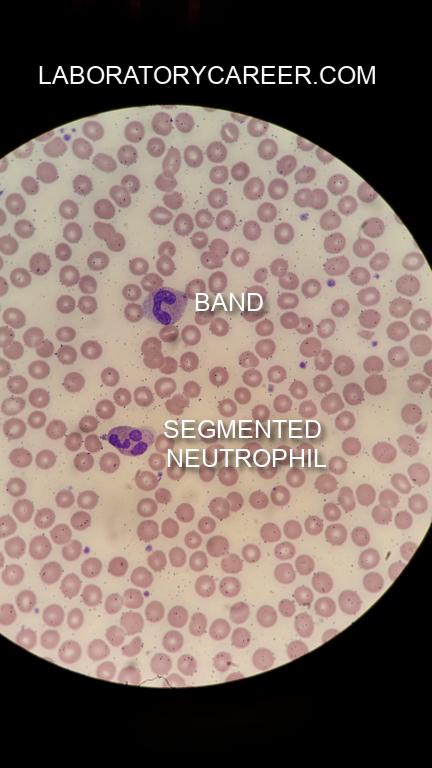 lab_career's tweet photo. NEUTROPHILS are white blood cells that help fight infection. You want more Segmented Neutrophils (Segs) vs immature bands (U shaped). The Segs can "eat" bacteria causing the infection (aka phagocytosis). #clinicallabscience #medicaltechnology #sciencemajor #stemjobs #labcareer https://t.co/siqgePfMkw