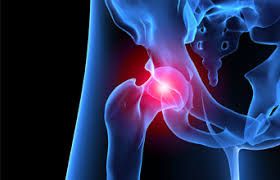KEYChiroMidland's tweet photo. HEALTHY HIPS 2020
Hip dysplasia is the most common cause of hip arthritis in adults. 1 in 6 newborns have some hip instability. https://t.co/eD5zVStf4S. If you have any hip concerns (infants, children or adults) call KEY Chiropractic on 9274 1471. We’re here to help! https://t.co/hbqo7fp5sJ