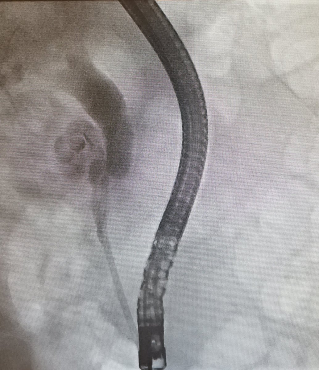 RashidLui's tweet photo. #2 CBD stenting for a complex cystic pancreatic head lesion
40ish man with history of brain and kidney surgery + distal pancreatectomy for NET. Care to take a guess at a possible underlying genetic syndrome?
#VirtualEndoscopy #DistanceMedEd #gitwitter #some4endoscopy https://t.co/3M8E6NTTHt