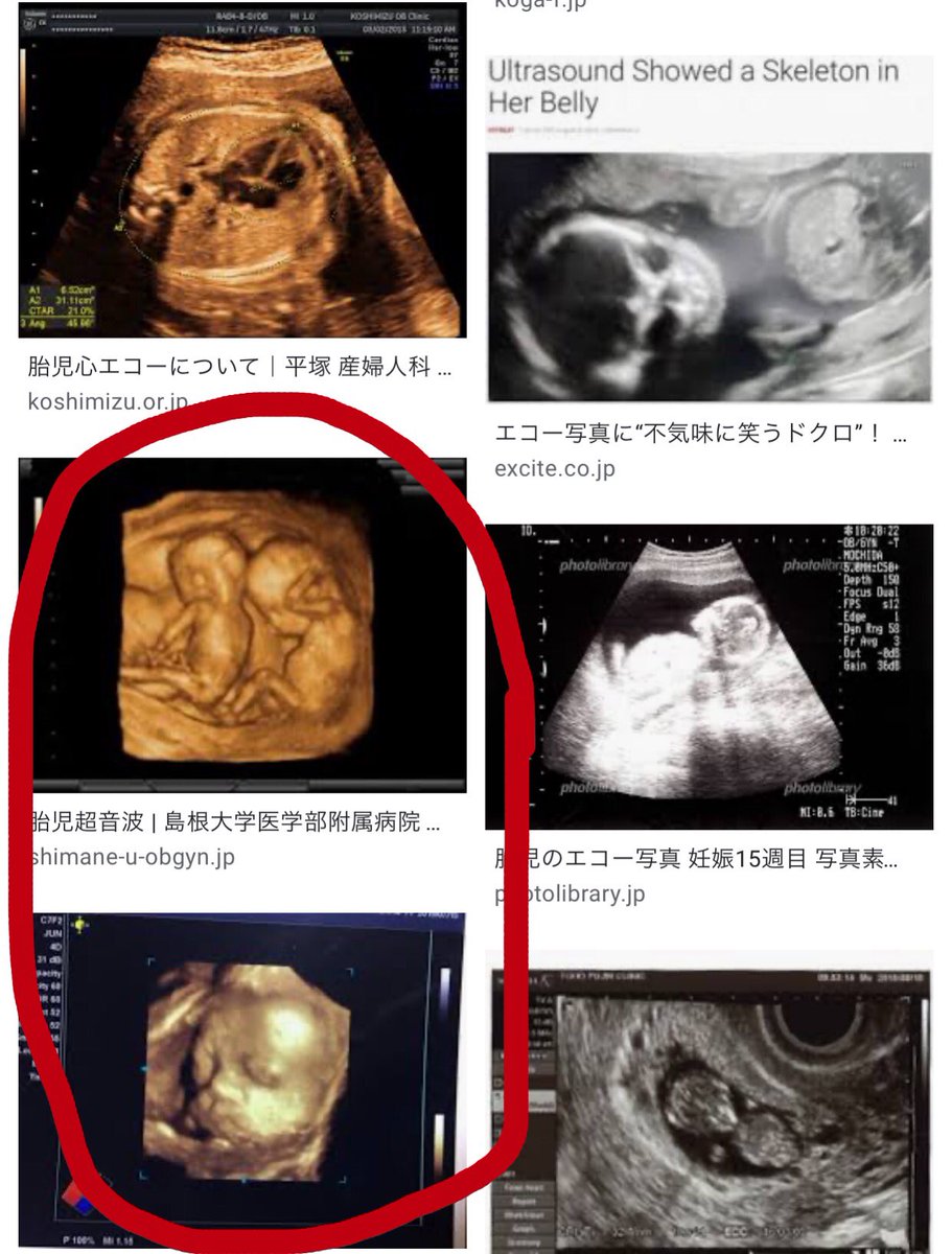 フロッグログロック Yurukuyaru これはネタ写真ですか もし胎児であるならエコーでも 3dでもこのような写り方はしないと思います 何で撮影したのでしょうかね 赤 で囲われた写真が3d撮影 比較的最新 その他が一般的なエコー写真 従来の超音波