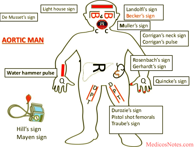 UTHSCPAprogram's tweet image. Answer: Landolfi's Sign

Manifestation of wide pulse pressure and large stroke volume in the iridial vessels, which causes systolic constriction and diastolic dilation of the pupils.

Patient had aortic regurgitation with Stanford A aortic dissection

nejm.org/doi/full/10.10…