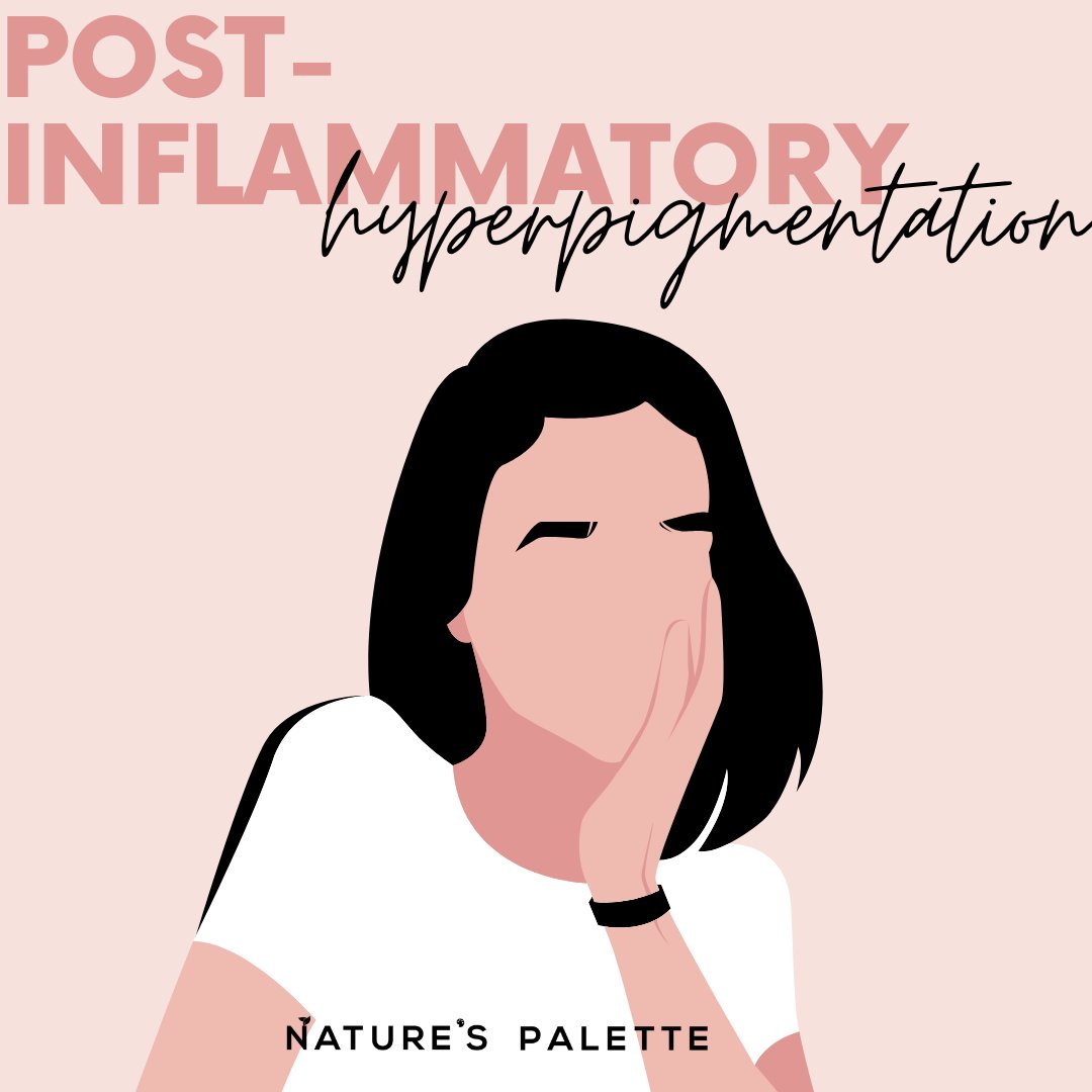 First off, let’s discuss PIH. PIH stands for Post-Inflammatory Hyperpigmentation. PIH occurs when excess melanin production is triggered due to inflammation. As a result of melanin overproduction, discolouration of the skin can be seen on your face.