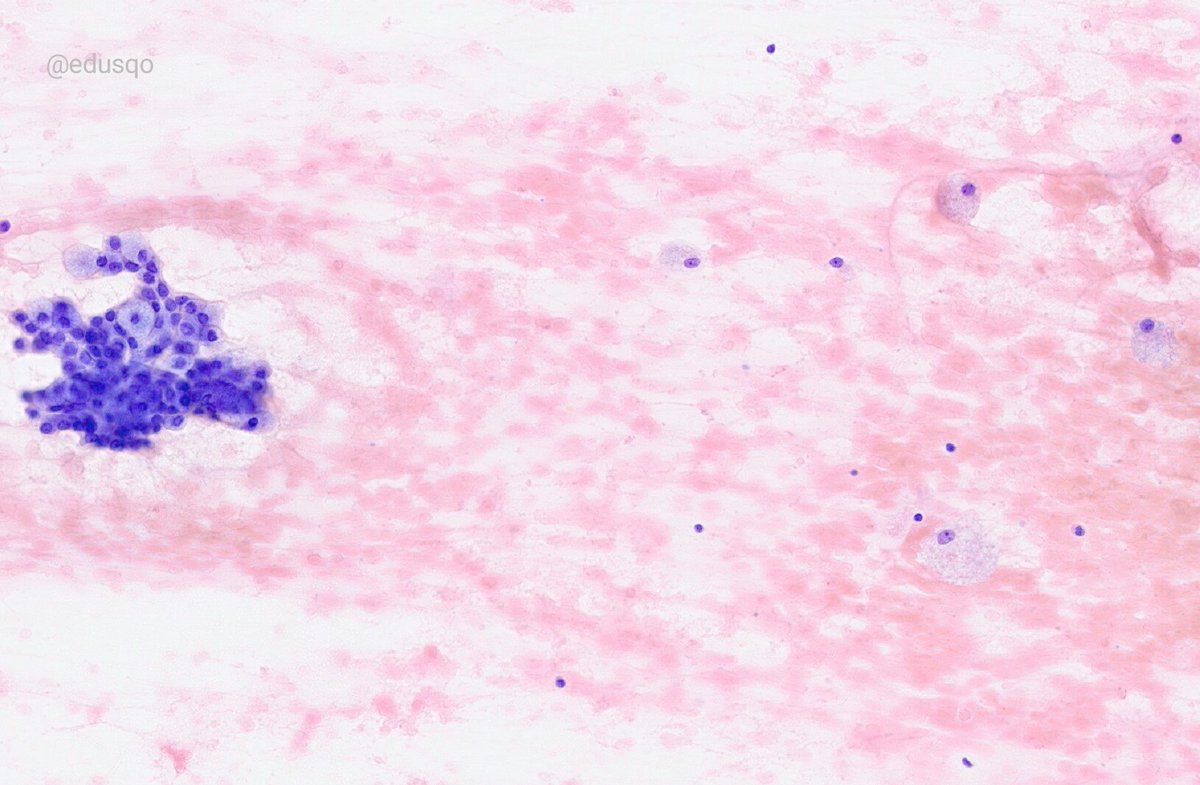 edusqo's tweet image. #FNAFriday Low Grade Mucoepidermoid carcinoma in the parotid gland. 
▫most common malignancy
▫mucin-filled cystic lesion
▫mucinous, intermediate and squamoid cells
▫bland-looking nuclei
▫DDx: Warthin or Pleomorphic Adenoma w squamous/mucinous metaplasia 
#ENTPath #CellBlock