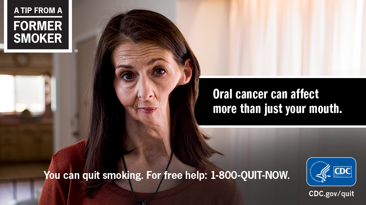 chewing tobacco cancer stories Christine smoked and lost her jaw to oral cancer caused by smoking. Read  her story: https://t.co/HBiJ2Aq8lD #CDCTips #OralHealthAwarenessMonth