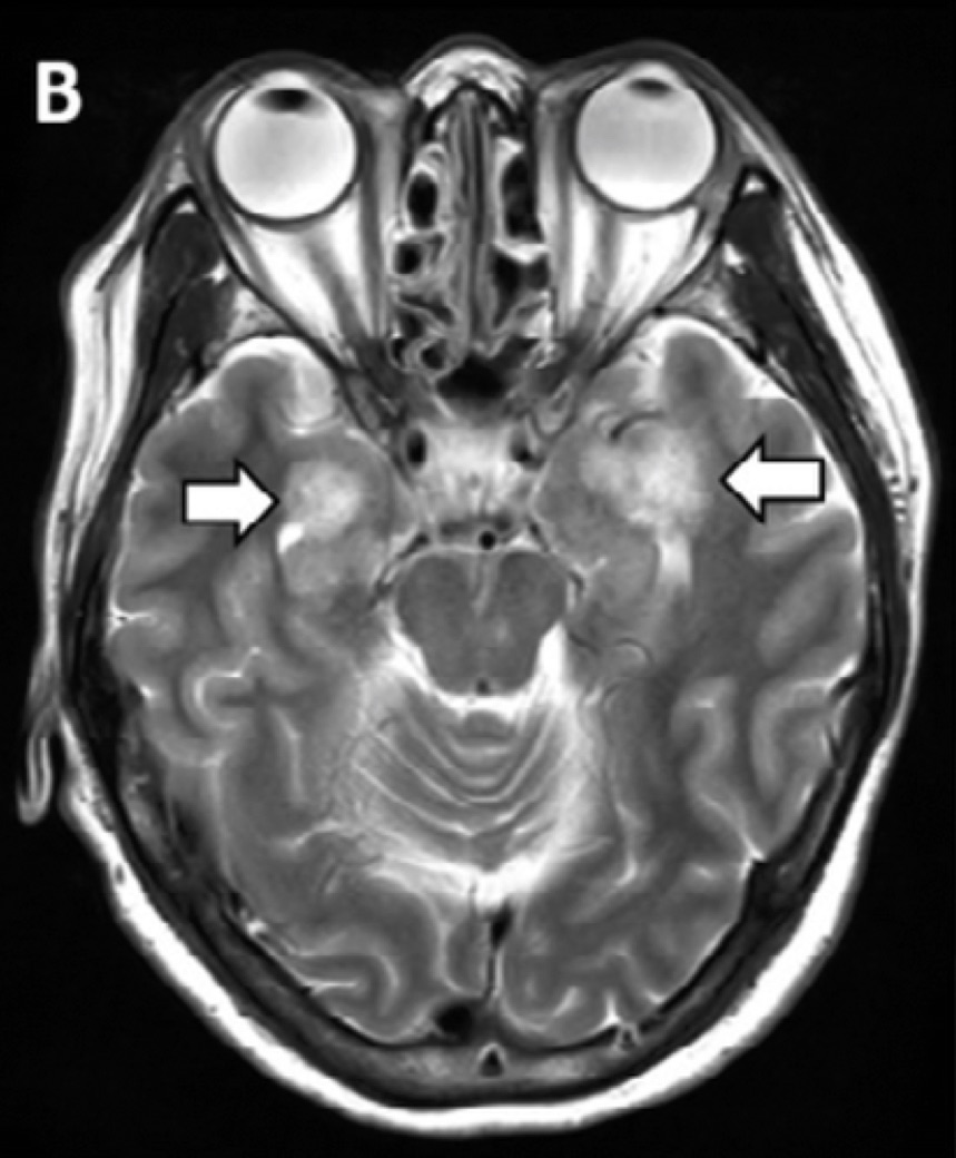 macfadyen_a's tweet photo. In severe infections, cytokine storms may break down the blood-brain barriers which may result in intracranial hemorrhagic lesions: 
#Biom4180 https://t.co/tqtrv1FfI8