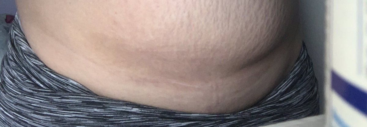 spencnaomi's tweet photo. 10 days after and 10 months after. If it wasn’t for an emergency c section me and my daughter might not be here right now. My doctor was so amazing making that call when he did. And even more amazing for making that scar line Invisible asf 😌#allscarsheal #csectionawarnessmonth https://t.co/5W9VFK9CPx