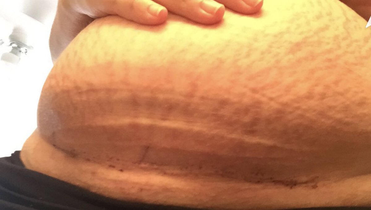 spencnaomi's tweet photo. 10 days after and 10 months after. If it wasn’t for an emergency c section me and my daughter might not be here right now. My doctor was so amazing making that call when he did. And even more amazing for making that scar line Invisible asf 😌#allscarsheal #csectionawarnessmonth https://t.co/5W9VFK9CPx