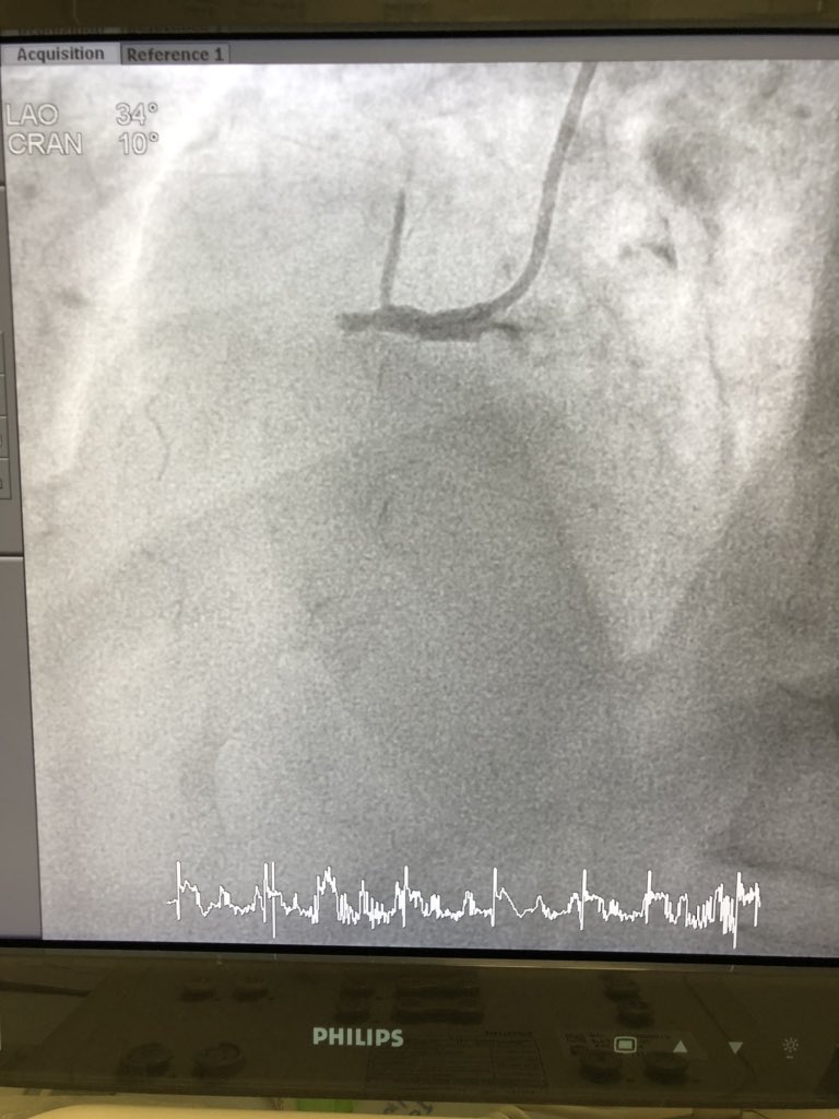 sazzlikasim's tweet image. #COVID19 forces doctors to treat heart attacks conservatively. Now theres gonna be a lot more rescue PCIs! 
- It is not easy to see and work with faceshields as it keeps fogging up! @UiTMCardio @uitmofficial @huitmofficial #SafetyFirst #stemis #FOAMed