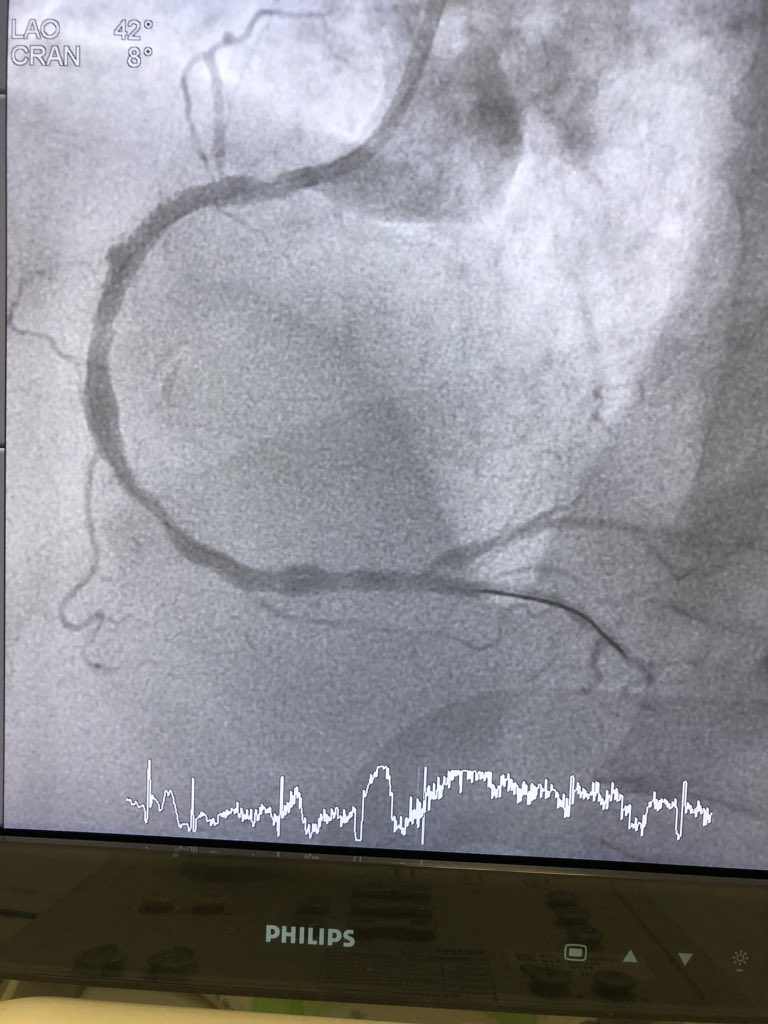 sazzlikasim's tweet image. #COVID19 forces doctors to treat heart attacks conservatively. Now theres gonna be a lot more rescue PCIs! 
- It is not easy to see and work with faceshields as it keeps fogging up! @UiTMCardio @uitmofficial @huitmofficial #SafetyFirst #stemis #FOAMed