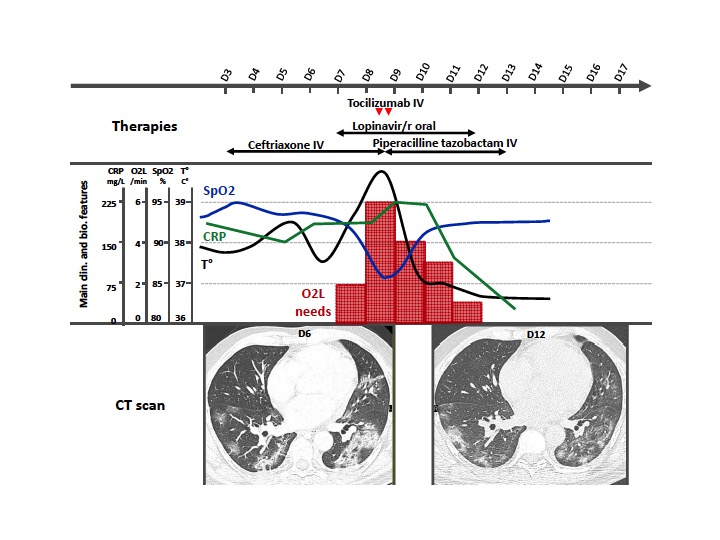 Annals_Oncology's tweet photo. Letter to the Editor in Annals of Oncology reporting the successful treatment of a patient with cancer and severe pulmonary manifestations of #COVID19 with Tocilizumab, anti-IL6 receptor moAb used for treating CRS seen with CAR-Ts @MichotJM @GustaveRoussy  https://t.co/mrNJ3T1DEX https://t.co/4c4GCr8rTn