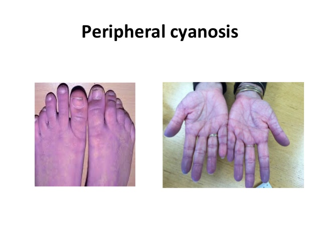 ぷくろう英語 Peripheral Cyanosis 末梢性チアノーゼ