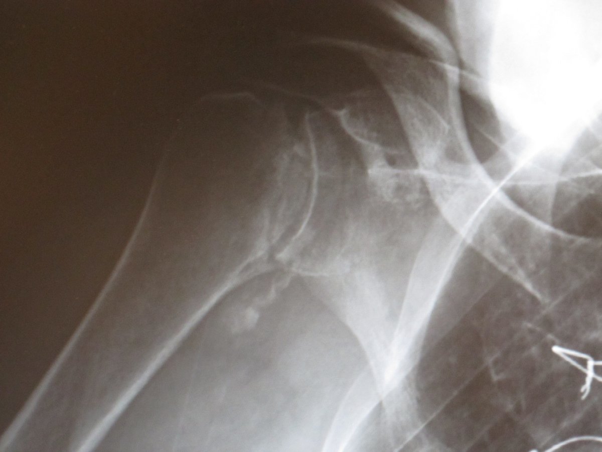 Members of the ASES have suspended elective surgeries while the #COVID-19 outbreak is in full swing. But we are still treating urgent fractures, infections and tumors.