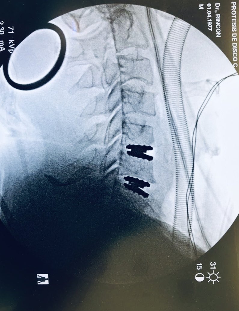 dr_raulrincon's tweet photo. Casual, convirtiendo una columna cervical rígida, en una columna móvil y completamente funcional.
¿Han escuchado la frase “lo barato sale caro”? Bueno, aquí aplica. #spinesurgery #neurosurgery #badsurgery #goodsurgery #artroplastia #arthroplasty #movement #nspclinic @nspclinic https://t.co/Zt72CYQUXx
