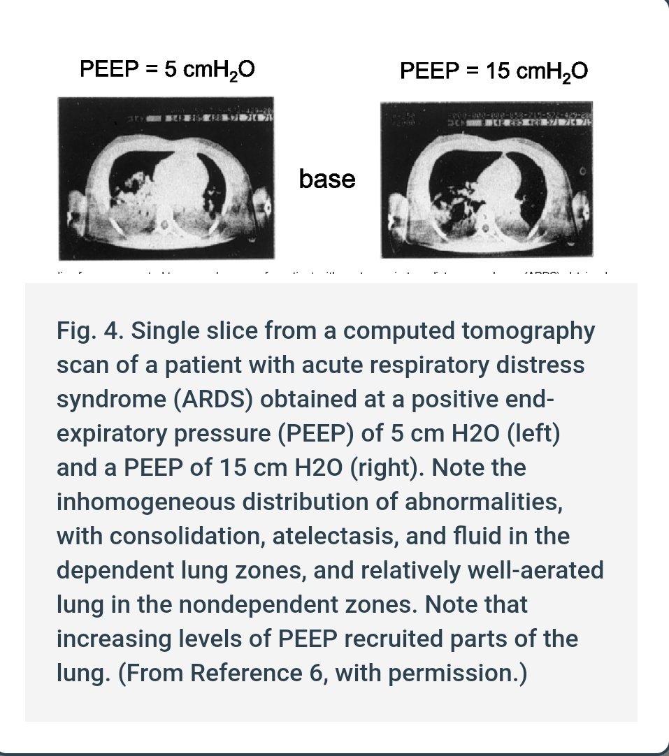 ARDS often requires rather extreme PEEP settings to recruit damaged regions of the lungs-- in other words, to un-collapse the swollen and fluid-soaked areas.Meanwhile, negative-pressure ventilation is free of barotrauma at all and still achieves greater oxygenation in ARDS.