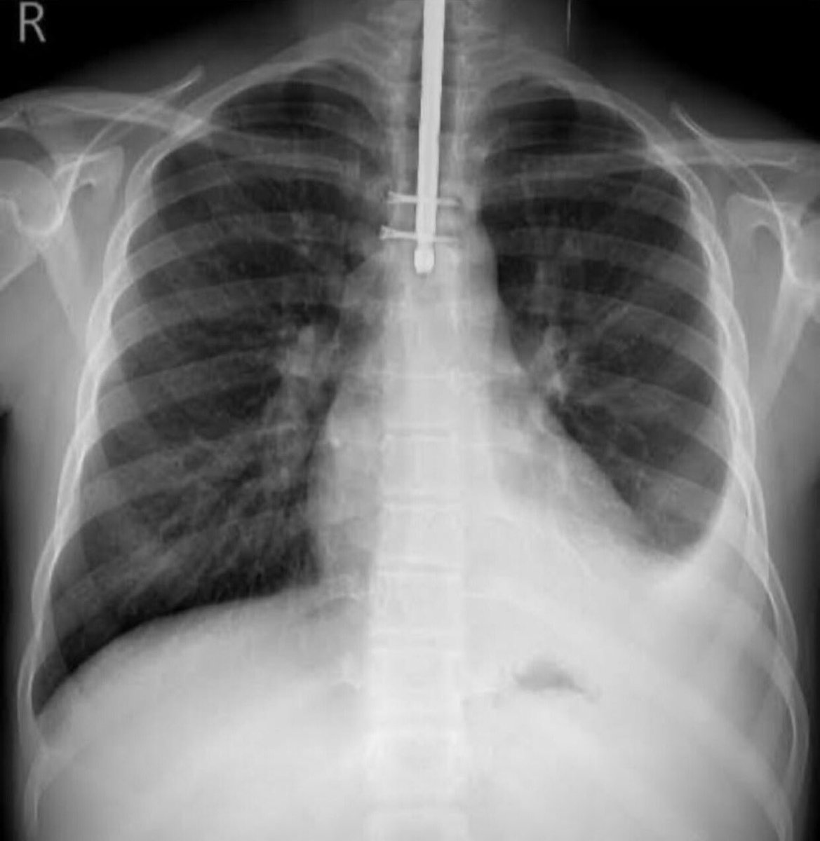 H2O_SportsMD's tweet photo. Intubation is complete. #Orthopedics #PerfectCircles #AbsoluteStability #TourniquetDown https://t.co/GlM2KukL7b