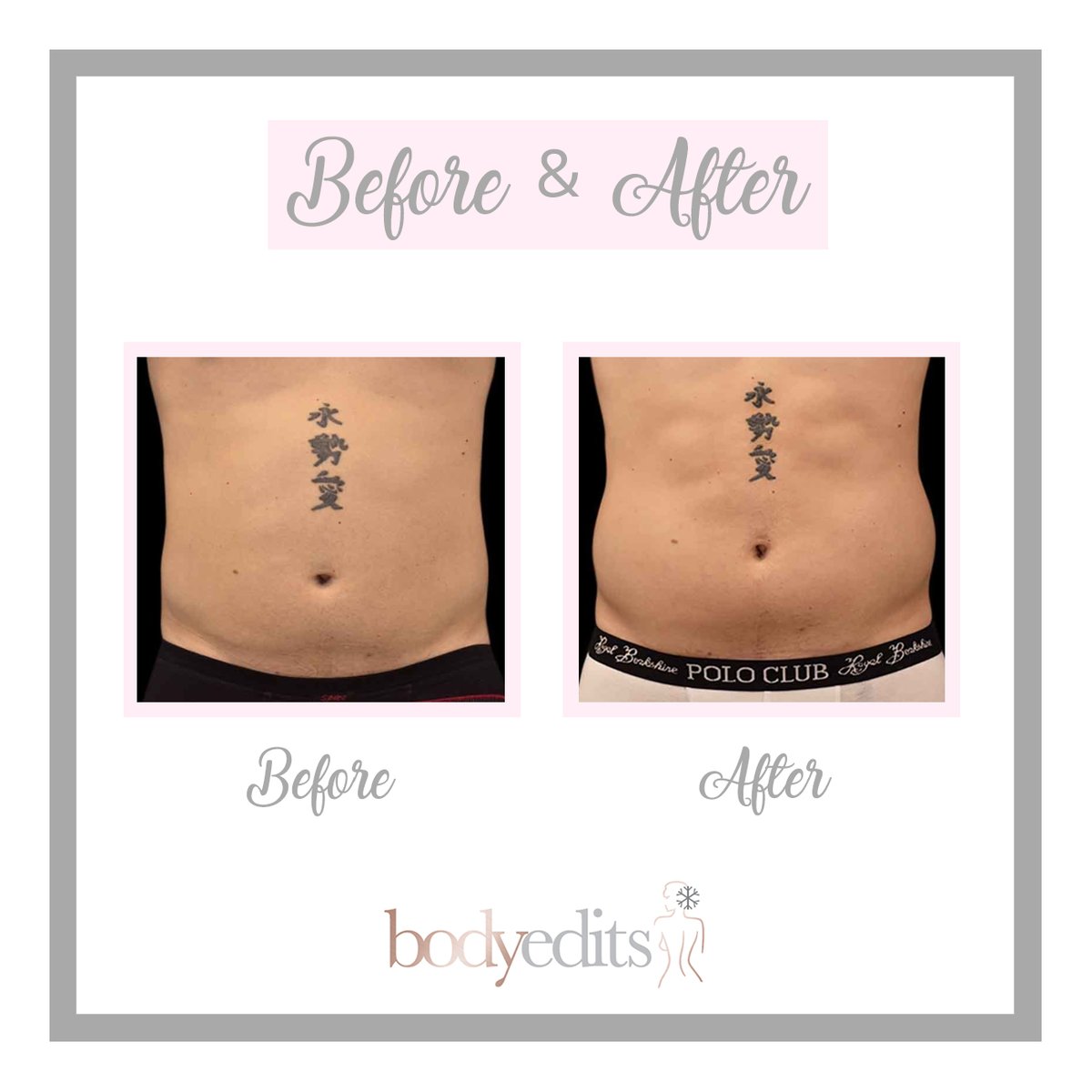 Sadaf_Jaffari's tweet photo. Fantastic results from EMSculpt on a males abdomen to burn fat and sculpt the abs! 
#emsculpt #bodysculpting #gains #musclegain #fitfam https://t.co/cgKwaQ7I6l