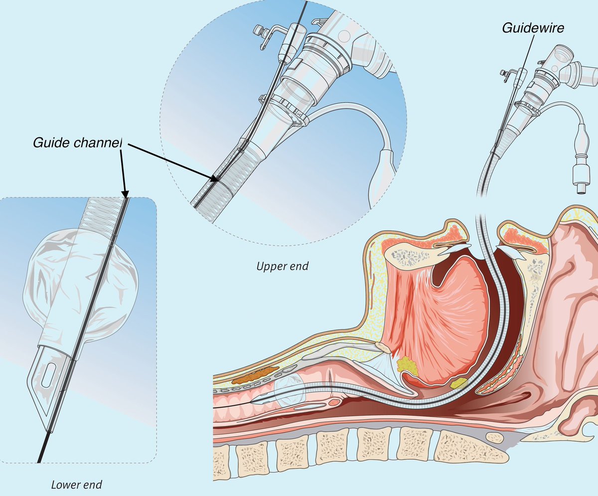 Moreover, access to the lungs themselves is actually *blocked* by the tracheal balloon used in endotracheal intubation.This requires frequent suctioning of secretions to prevent suffocation, and still mechanically obstructs their removal.It also blocks tracheal endoscopy.