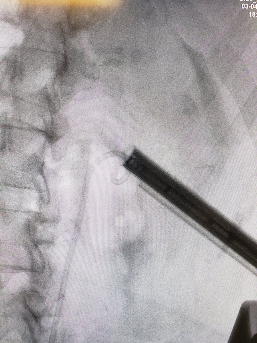 DrRodriguezUro's tweet photo. NLPC
Single Shot
Coral Calculi
Result: Stone Free

#monterrey #urology #endourology #nlpc #lithiasis https://t.co/s5nu3rmve3