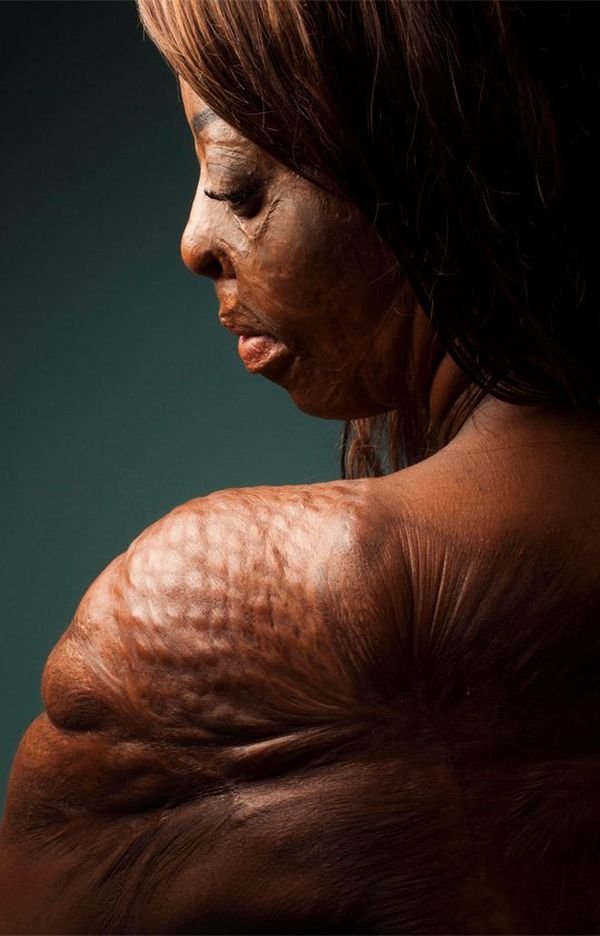 Sophie Mayanne (1993)Cette photographe anglaise mène notamment le projet "Behind The Scars" depuis 2017, série de portraits pleine d'empowerment, qui compte déjà plus de 450 histoires de cicatrices.